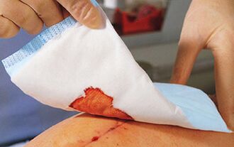 After penis enlargement surgery, dressings need to be done