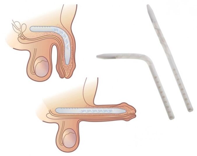 Falloplasty to increase a member