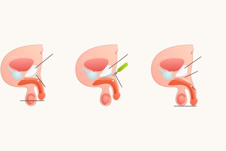 Ligationtomy to increase the penis