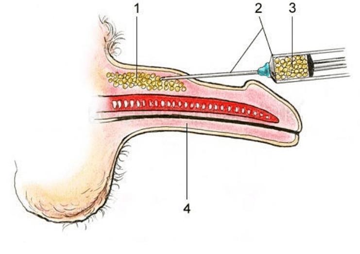 lipofiling to increase a member