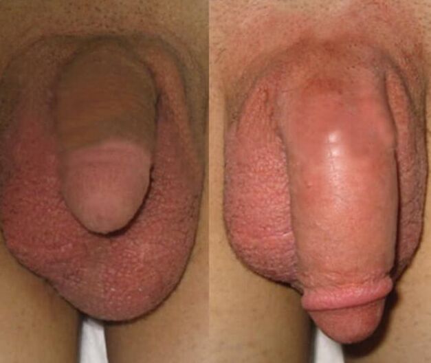 The result of the installation of a collagen matrix in the penis