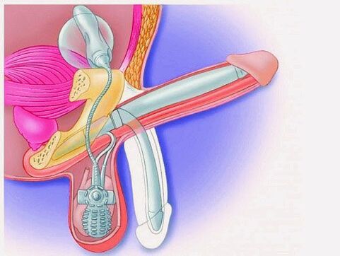 Penis enlargement via penile prosthesis